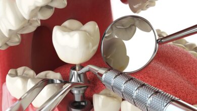 Signs You Need Denture Implants