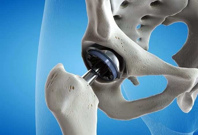 Medical PEEK: The Revolutionary Material For Medical Implants